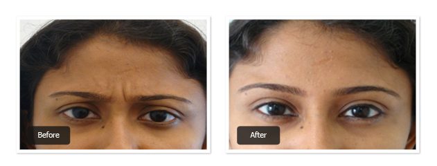 pre & post images of botox treatment