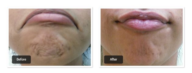 pre & post images of lip filler treatment