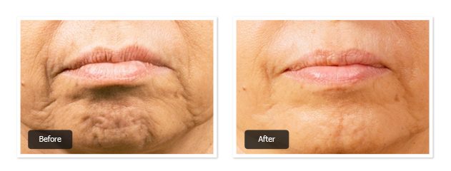 pre & post images of lip filler treatment