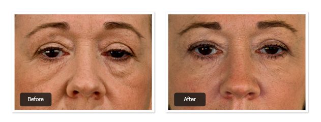 pre & post images of botox treatment