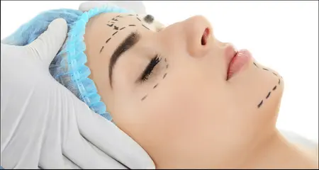 Botox treatment markings for face