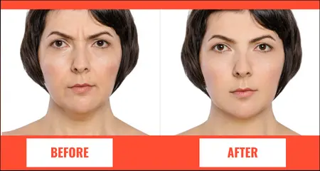 Botox treatment- overall face of girl having short hairs- before- after