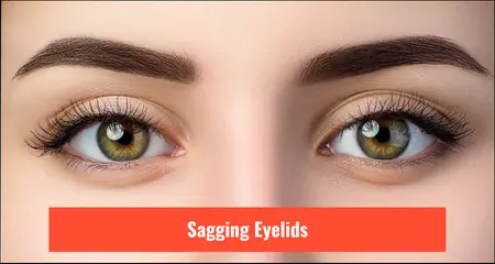 Sagging eyelids