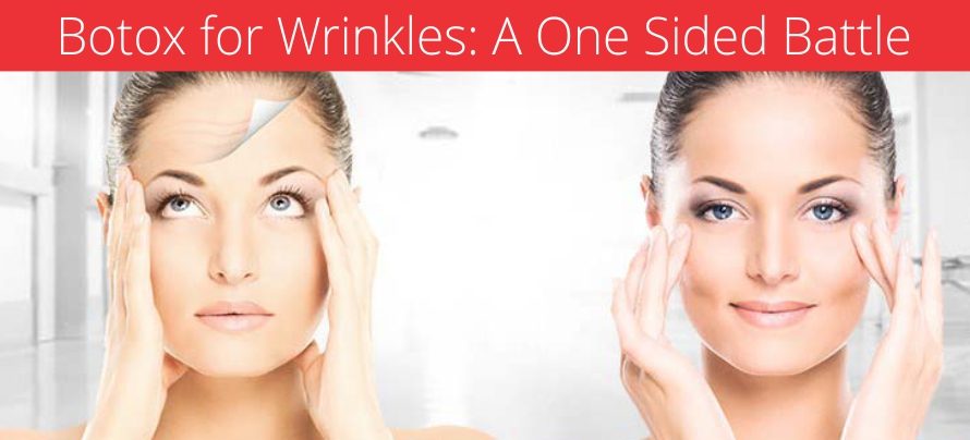 BOTOX FOR WRINKLES: A ONE SIDED BATTLE